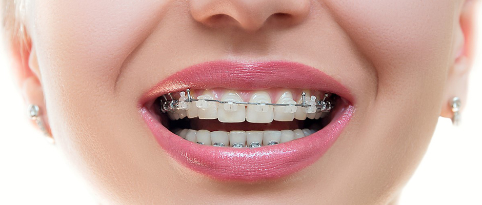 Ortodonti tedavisi estetiğe rakip