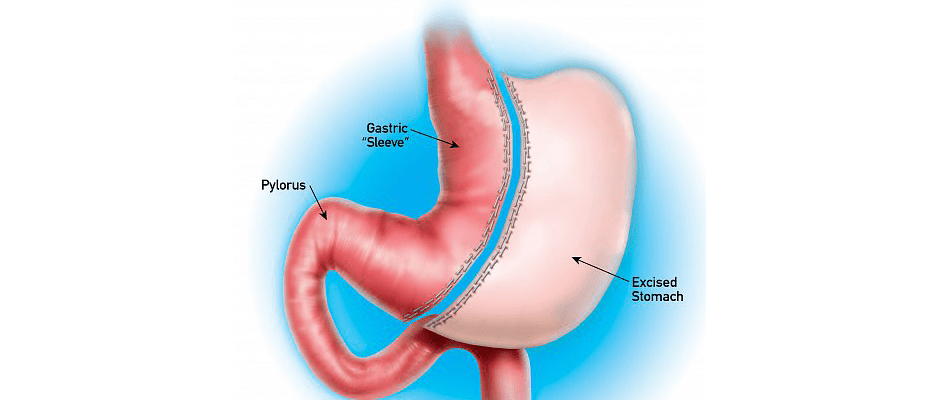 Türkiye'de yılda yaklaşık 9 bin kişi mide küçültme ameliyatı oluyor