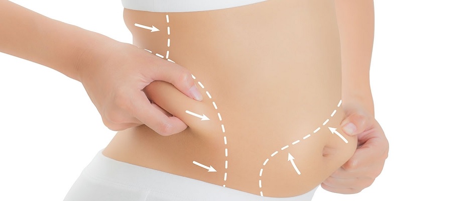Liposuction Nedir? Yöntemleri Nelerdir?