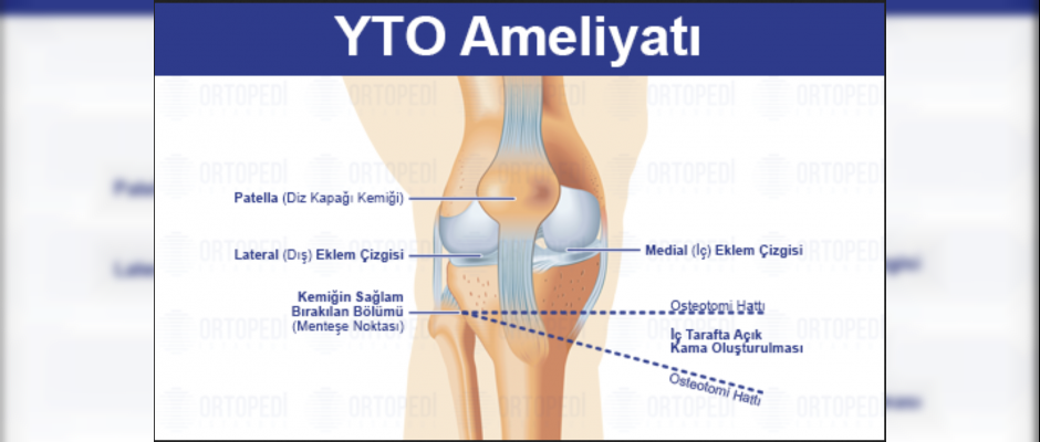 Yüksek Tibial Osteotomi (YTO): Diz Ağrısından Fonksiyona Giden Yol, Aklınızdaki Tüm Sorular ve Bizce En Mantıklı İyileşme Stratejisi