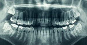 Kök hücre dolguları ile diş çürükleri tarih olabilir mi?