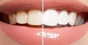 Kömürle diş beyazlatma uygulamalarının tehlikeleri