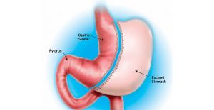 Türkiye'de yılda yaklaşık 9 bin kişi mide küçültme ameliyatı oluyor