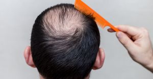 Saç ekiminde risk: Tehlike saçan saç ekim merkezleri