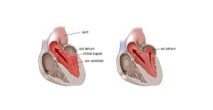 Kalbin içindeki mucize: Mitral kapak