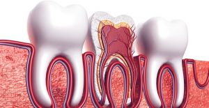 Kulağa vuran diş ağrısı pulpitis kaynaklı olabilir mi, kanal tedavisi nedir?